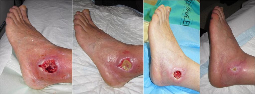 Ayurvedic Treatment for Diabetic Foot