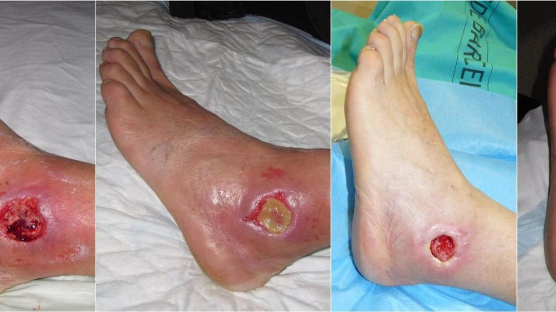 Ayurvedic Treatment for Diabetic Foot