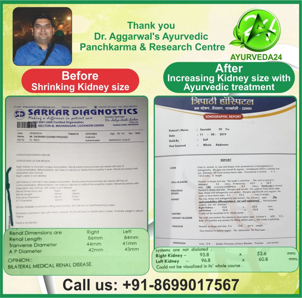 ayurvedic-treatment-kidney-failure