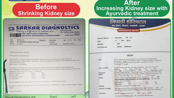 ayurvedic-treatment-kidney-failure