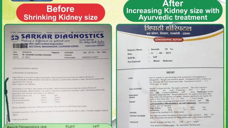 ayurvedic-treatment-kidney-failure