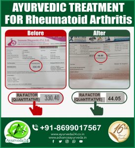 Ayurveda Treatment for Rheumatoid Arthritis